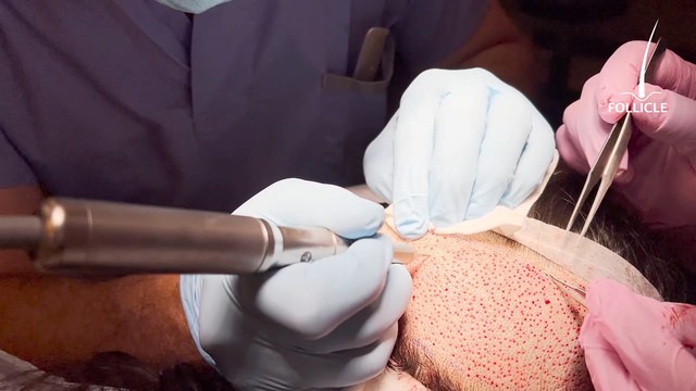 FUE Hair Transplant Surgery on Women Patient 1