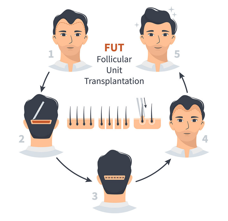 FUT Hair Restoration Technique