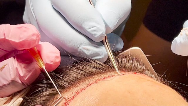 Hairline Lowering Procedure