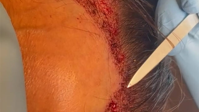 Hairline Lowering Final Result During the Surgery