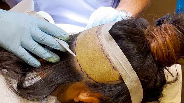 FUE Hairline Lowering Step 1 - Preparing patient