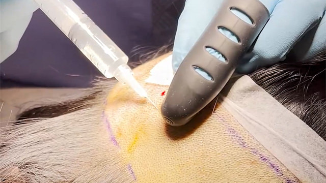 FUE Hairline Lowering Step 2 - Injecting freezing medication to a donnor area