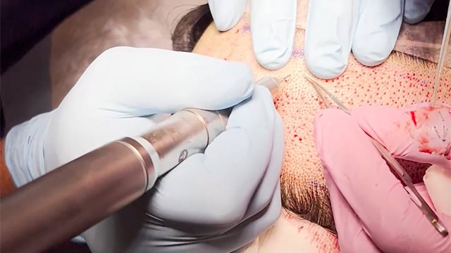 FUE Hairline Lowering Step 3 - Follicle unit extraction