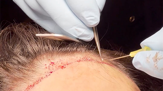 FUE Hairline Lowering Step 6 - Implanting hair follicle
