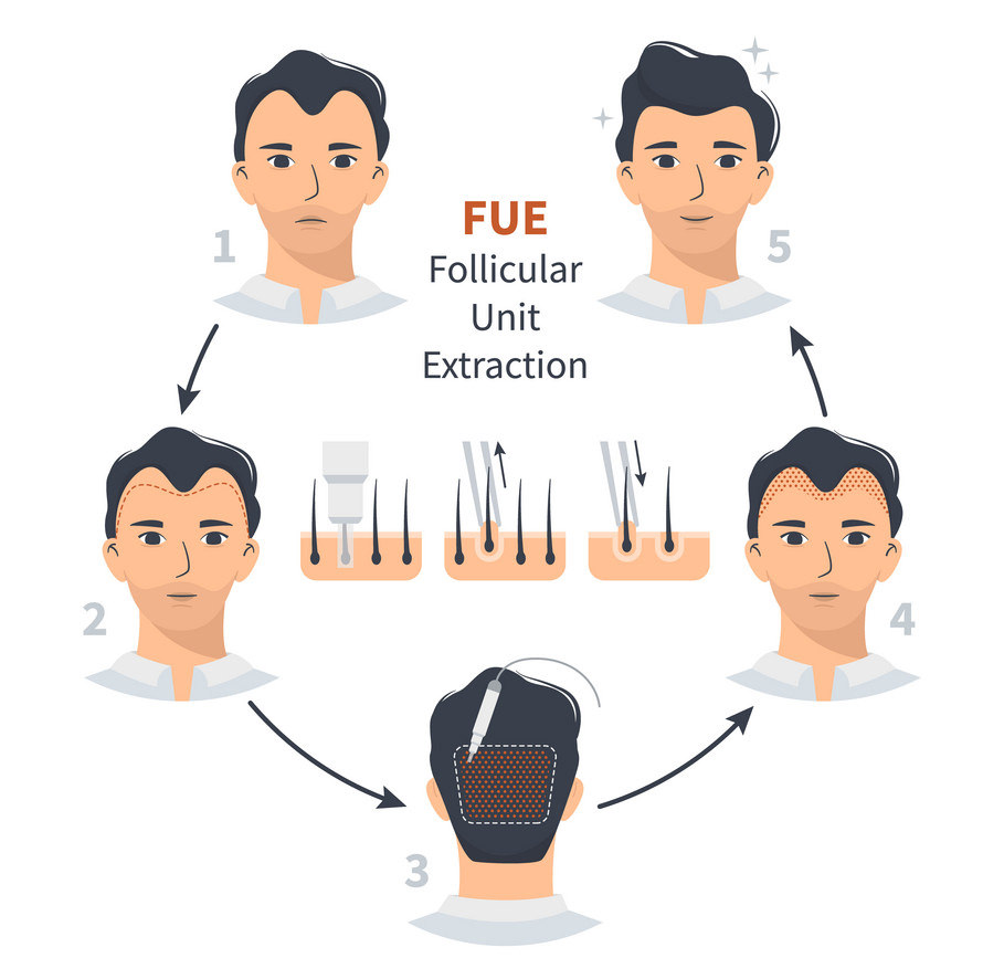 FUE hair restoration technique
