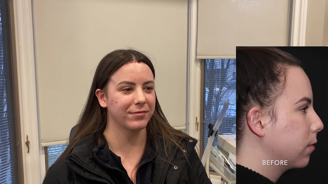Hairline Lowering Surgery Before and After Results