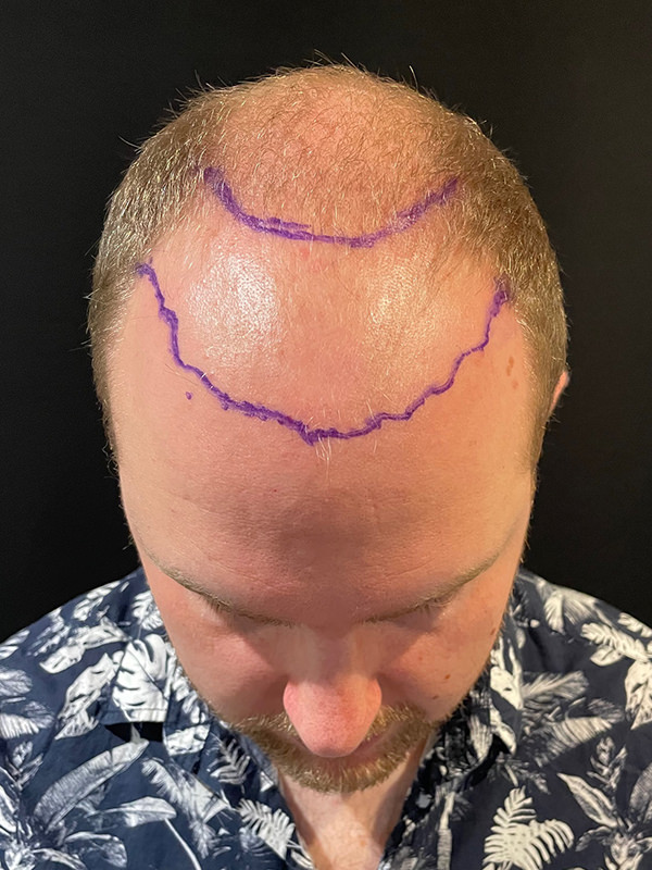 Your hair transplant experience