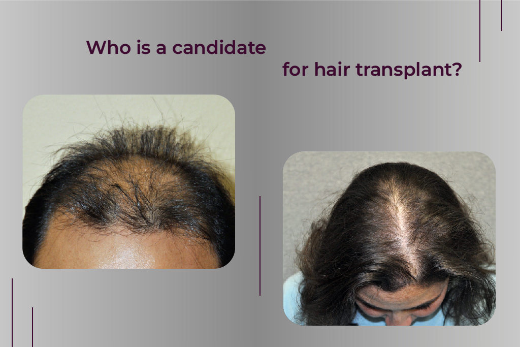 Who is a candidate for a hair transplant?