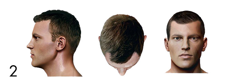 hair loss pattern