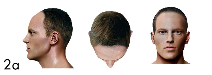 hair loss pattern
