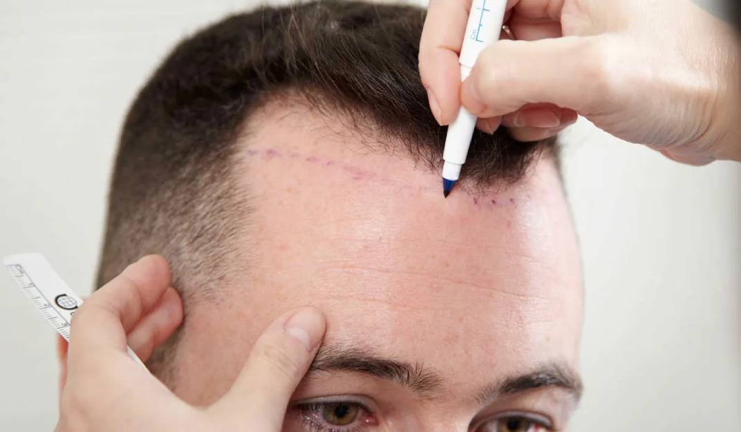 The benefits of FUE Hair Restoration