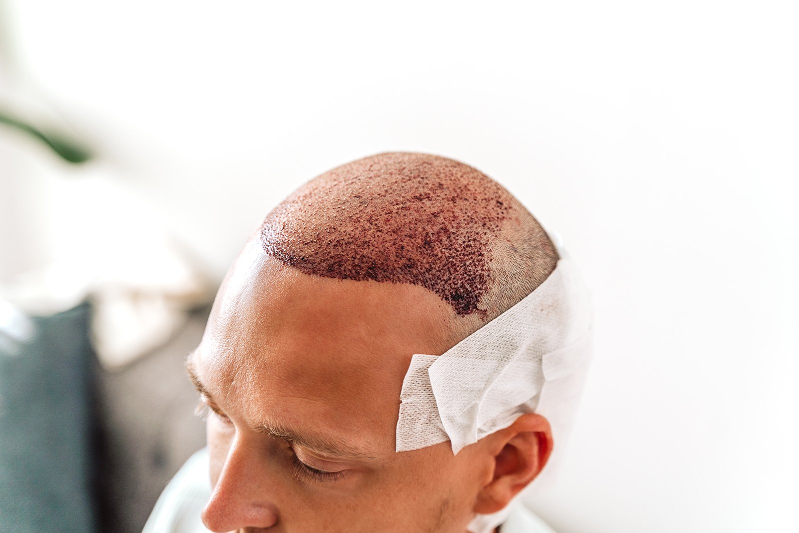 What is an FUE hair transplant?
