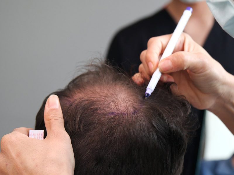 A Comprehensive Guide to FUE Hair Transplant in Toronto