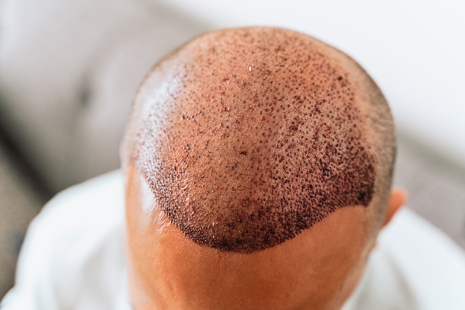 What is a FUE Hair Transplant?